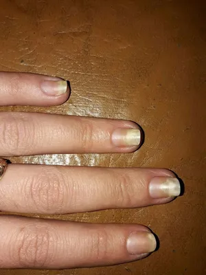 Как лечить грибок ногтей - Coolaser Clinic