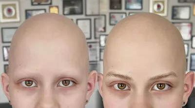 Болеет с 3-х летнего возраста. alopecia totalis (тотальная алопеция)  Обратилась в клинику в 18-ти летнем возрасте, через 15 лет от начала  развития заболева… | Cejas