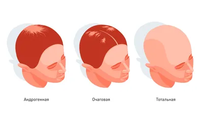 Тотальная алопеция: причины, симптомы и лечение тотального облысения