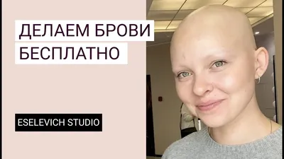Тотальная алопеция, женщина с тотальной алопецией, начали выпадать волосы —  что делать - 21 сентября 2020 - НГС.ру