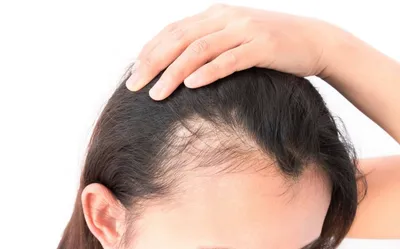 Алопеции - все виды это заболевания волос | Трихолог - Винница