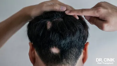 Система волос - новый революционный метод замещения волос
