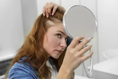 Системы волос и волосы на лентах on Instagram: \"▫️Виды алопеции у женщин:  1️⃣ Андрогенная алопеция (Широкая зона пробора волос) Истончение волос,  ведущее к поредению волос в области центрального пробора головы и на