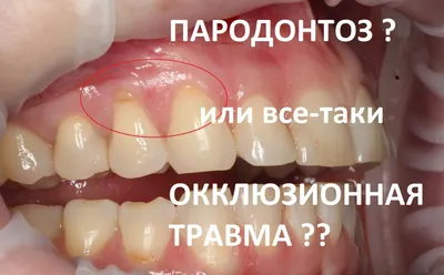 Почему пародонтоз нельзя считать диагнозом? - мнение пародонтолога ТОП1  клиники Москвы Немецкий Имплантологический Центр