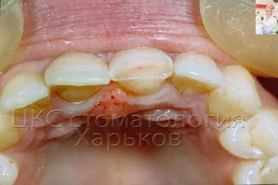 Травма зуба, перелом коронковой части переднего зуба. Реставрация  фотополимером