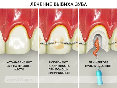 Перелом зуба