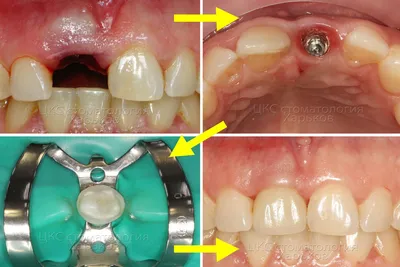 Имплантация в области фронтальных и боковых зубов (восстановление после  травмы - Эстетика