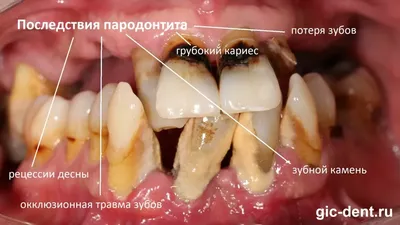 Воспаление десен – лечение, как снять, чем полоскать (лекарство, мазь,  антибиотик)