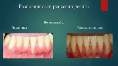 Опустилась десна – симптомы, причины, консервативное и хирургическое лечение