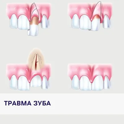 Лечение травмы молочных зубов - детская стомалогия Nikadent Family