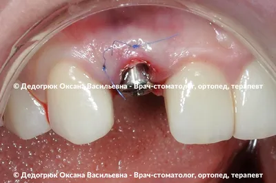 Вертикальный перелом зуба