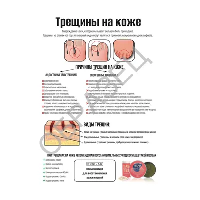 Трещины на сосках, причины и как лечить