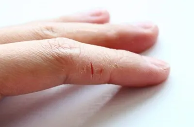 Трещины на коже рук - причины, симптомы, лечение - Полемика