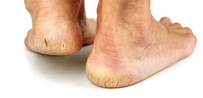 Ноги Пациента Диабетом Диабетическая Нога Гиперкератоз Трещины Коже Ноги  Крупный стоковое фото ©zhannaza 372657756