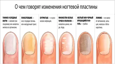 Избавление от онихорексиса (продольное расслоение) ногтевой пластины в  Центре подологии СТОПАМЕР