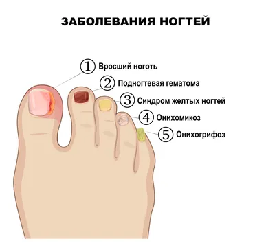 Грибок ногтей (Онихомикоз): причины, симптомы, лечение, профилактика
