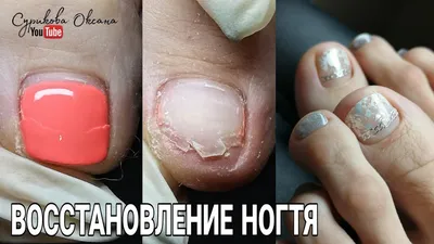 Трещина на ногте ноги что делать, советы подолога