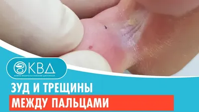 Лечение потемнения ногтя на ноге или руке - Центр NeoVita