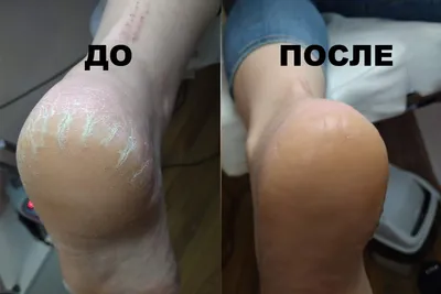 Чем лечить трещины на пятках — EVO Laboratoires