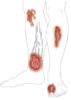 Трофические язвы: лечение, симптомы, профилактика - блог интернет-магазина  КАМА