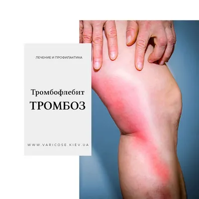 Тромбоз и тромбофлебит поверхностных вен нижних конечностей ⋆  varicose.kiev.ua