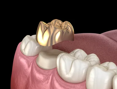 Металлические зубные коронки: насколько они долговечны