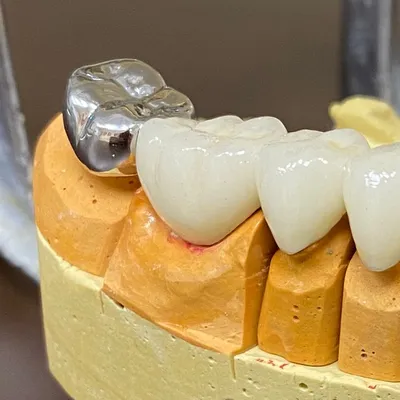 Зубные коронки - Стоматология Aliksma