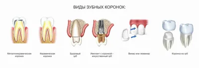 Установка коронок на зубы в Сургуте