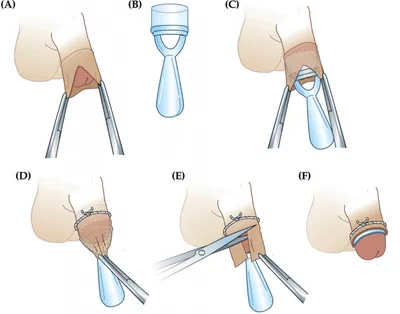 Обрезание крайней плоти (Циркумцизия) | Медцентр Авиценна