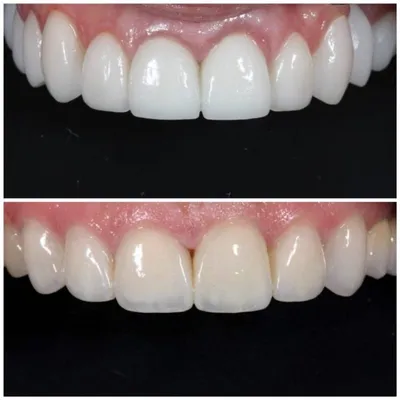 Dental Line Ukraine - Определение цвета зубов является одной из важнейших  задач эстетической стоматологии. Для этой цели врачи и зубные техники во  всем мире используют две основные шкалы Vita classic и Vita