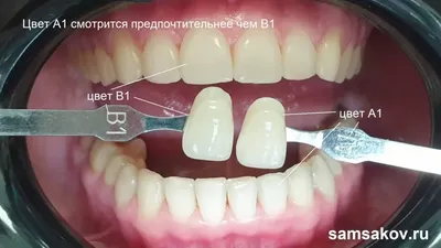 Виниры e-max улучшили форму зубов - стоматология Церекон, Москва