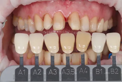 Протезирование цельнокерамическими реставрациями при дисколорите зубов -  DENTALMAGAZINE.RU