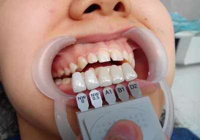 Результат профессионального отбеливания зубов системой ZOOM 4, фото до и  после Екатеринбург
