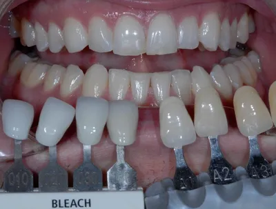 Отбеливание зубов и их реставрация лучше, чем ставить виниры. Альянс  бьюти-ортопедов, Москва