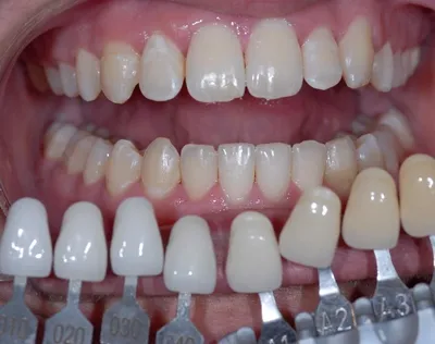 Отбеливание зубов: ответы на многие вопросы — Медицинский центр Вита Крон —  Стоматология в Кронштадте
