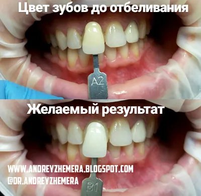 Как определить правильный цвет зубов? - YouTube