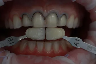 Виниры E.max после ортодонтического лечения (2915) - Ортопедия - Новости и  статьи по стоматологии - Профессиональный стоматологический портал (сайт)  «Клуб стоматологов»
