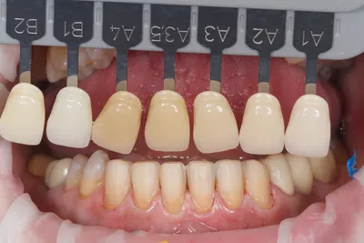 Протезирование цельнокерамическими реставрациями при дисколорите зубов -  DENTALMAGAZINE.RU