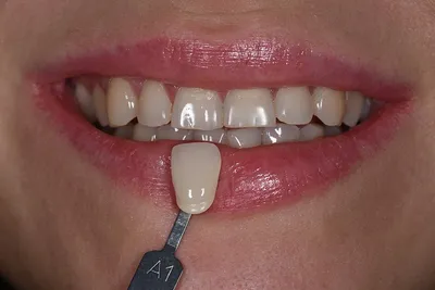 Дент-Хаус - 🦷Подбор цвета по шкале Vita. 🦷При пломбировании и других  процедурах для определения цвета зубов пациента используется шкала Вита.  Всем известный факт, что природный оттенок зубов человека не белый, а  немного
