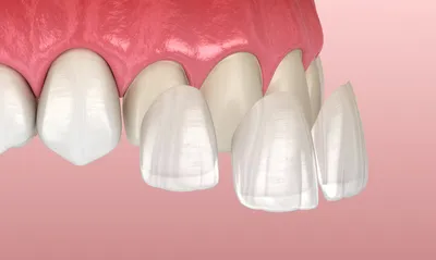Зубы \"Анис\" фронт верх, планка - 6 зубов, цвет B1, фасон 21, акриловые 3х  слойные купить недорого в интернет-магазине, цены оптом, фото, описание