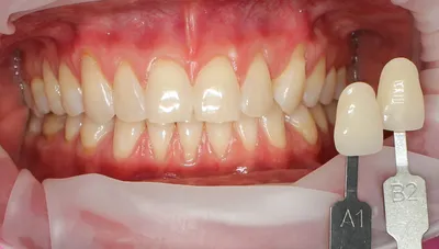 Эволюция отбеливания зубов: от исследований до клинического подтверждения