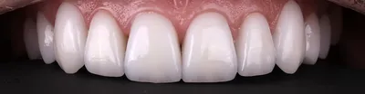 Отбеливание зубов с Insmile: кого выбрал врач? | Beauty Insider