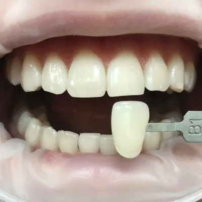 Клинический случай, пациентка А, 25 лет. Металлокерамическая коронка  (немецкая керамика) центрального резца. Штифт (культевая вкладка).  Отбеливание зубов