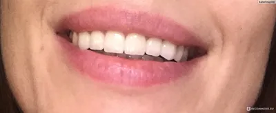 Зубы Анис Эксперт фронтальные верхние цвет-B1 форма-61 (крупные)