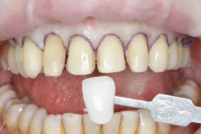 Энциклопедия цвета: какого оттенка должны быть зубы, и что об этом нужно  знать?