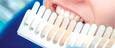 Виниры на зубы: главные особенности и характеристики — oShow