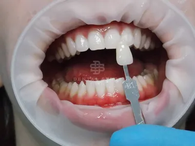 Протезирование на имплантах при врожденном отсутствии передних зубов  (первичная адентия)