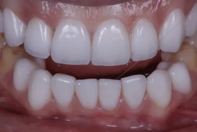 Определение цвета зубов - системы и способы