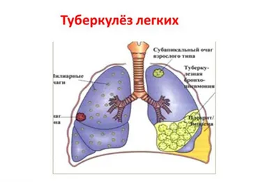 Что нужно знать о туберкулезе для личной безопасности?