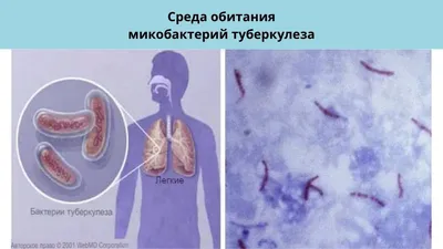 Туберкулез заразен и опасен — ГБУЗ СО Дегтярская Городская Больница